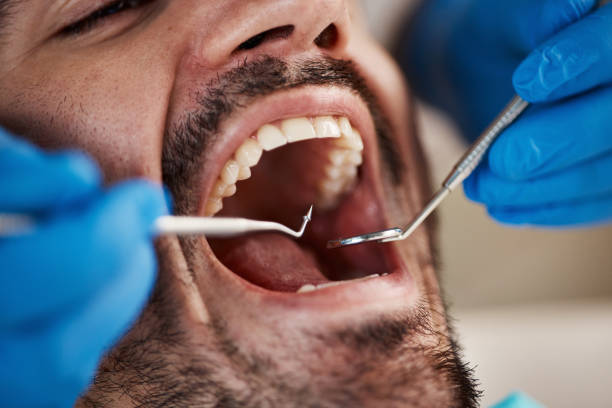 Best Emergency Wisdom Teeth Removal in Lumberton, MS
